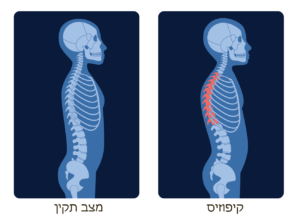 מצב עקמת קיפוזיס ומצב תקין
